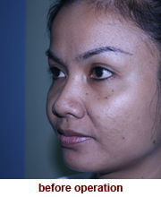 plastic_surgery_augmentation_rhinoplasty